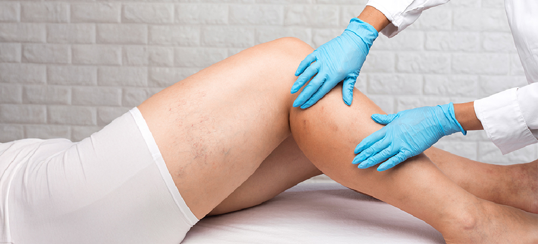 Chronic Venous Insufficiency Treatment  – RIVEA Vascular