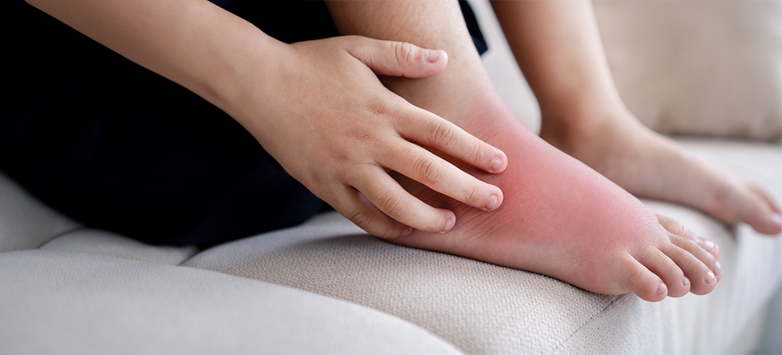 Lymphedema swelling in legs – RIVEA Vascular treatment