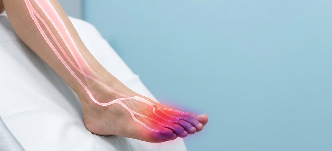 Learn about peripheral artery disease treatment, vascular care, and treatment options at Rivea Vascular.