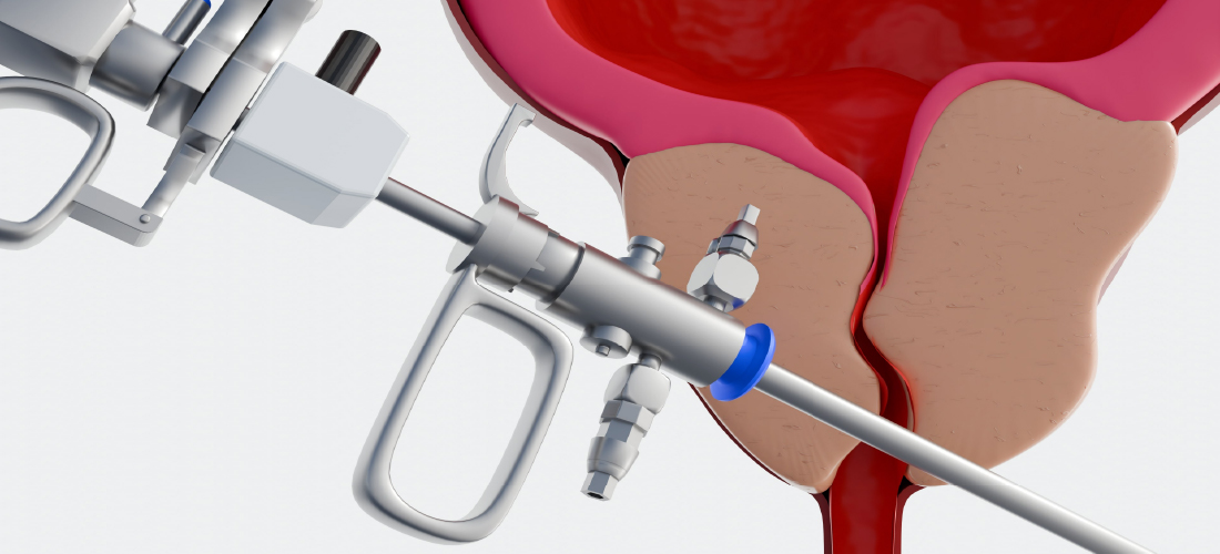 Transurethral resection of the prostate TURP treatment at Rivea Vascular Hyderabad
