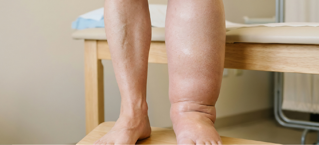 Lymphedema treatment in Hyderabad for better limb health