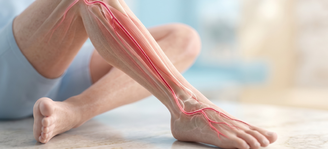 Peripheral artery disease risk factors, including diabetes, smoking, and high blood pressure | RIVEA Vascular Institute
