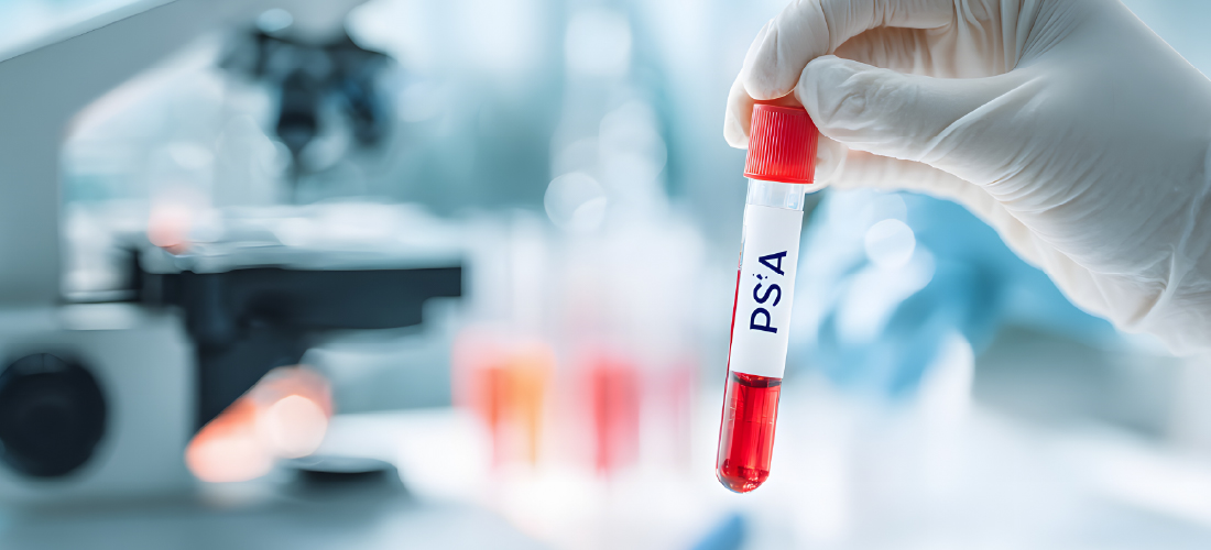 PSA blood test for prostate health and related conditions