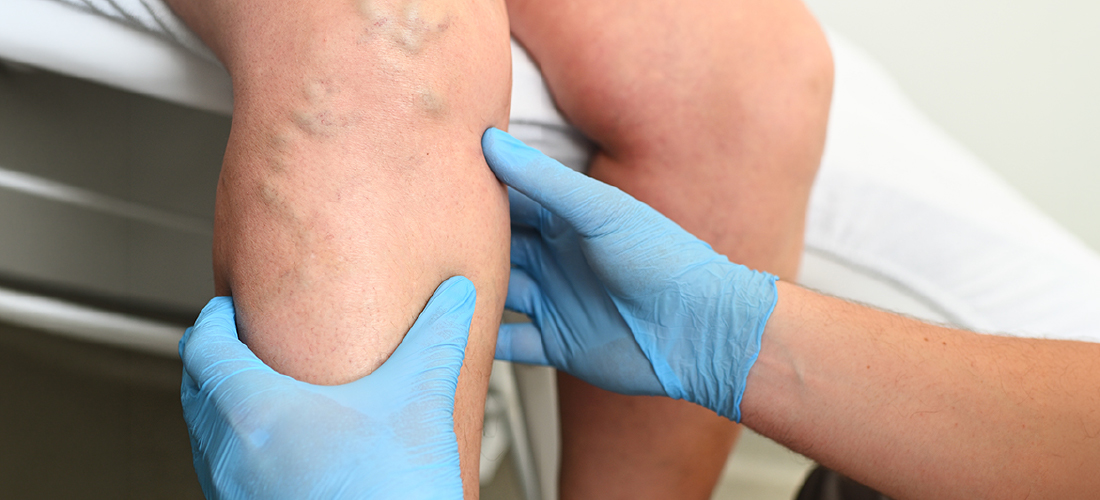 Varicose vein treatment in Hyderabad at Rivea Vascular