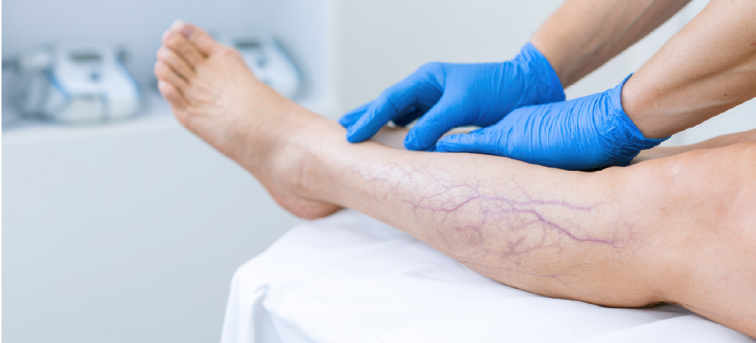 Expert varicose vein treatment by vascular specialists in Hyderabad